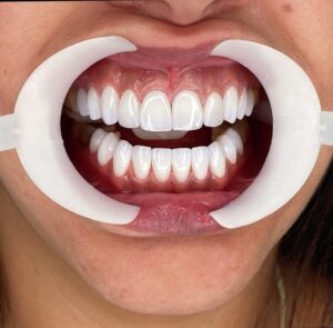 تعرف على تكلفة ابتسامة هوليوود في مصر 2025، وأسعار الفينير واللومينير، والفرق بين هوليوود سمايل والفينير، ومميزات العدسات التجميلية للأسنان. دليلك لاختيار أفضل دكتور تجميل أسنان للحصول على ابتسامة مثالية بأسعار مناسبة ونتائج طبيعية وثابتة.