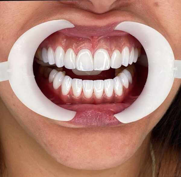 تعرف على تكلفة ابتسامة هوليوود في مصر 2025، وأسعار الفينير واللومينير، والفرق بين هوليوود سمايل والفينير، ومميزات العدسات التجميلية للأسنان. دليلك لاختيار أفضل دكتور تجميل أسنان للحصول على ابتسامة مثالية بأسعار مناسبة ونتائج طبيعية وثابتة.