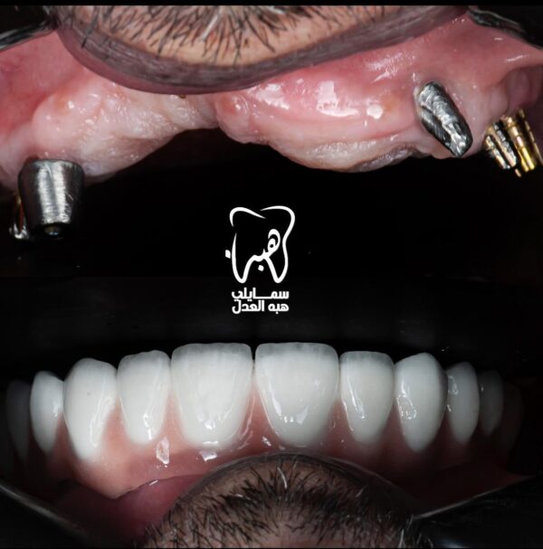 زراعة أسنان الفك السفلي هي عملية جراحية لاستبدال الأسنان المفقودة بجذور صناعية (مسامير تيتانيوم) تُثبت في عظم الفك، تليها مرحلة تركيب الأسنان البديلة. تتضمن العملية تقييمًا شاملاً، والتخدير، والزرع، ثم فترة شفاء قد تصل إلى 6 أشهر في بعض الحالات، مع الحاجة للالتزام بالتعليمات بعد الجراحة لضمان النجاح.