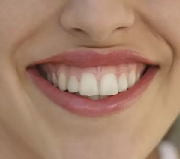 الابتسامة-اللثوية-.-اسباب-وعلاجها-.-فى-عيادة-دكتورة-هبة-العدل-.-افضل-دكتورة-اسنان-فى-مصر-