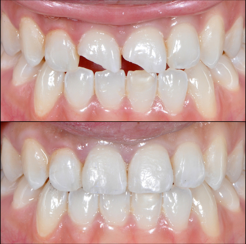 "تجميل الأسنان في مصر بخطوات آمنة ونتائج طبيعية.. الحشوات التجملية تعطى مظهر مميز للاسنان . عيادة اسنان دكتورة هبة العدل . افضل عيادة اسنان فى مصر