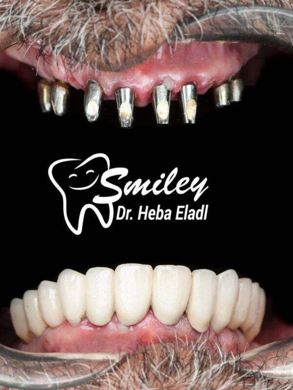 زراعة الأسنان في الفك السفلي تتطلب الكثير من الإجراءات والفحوص الطبية اللازمة مع طبيب تخدير محترف بحيث لا يكون هناك أي انعكاسات سلبية خلال عملية الزراعة.