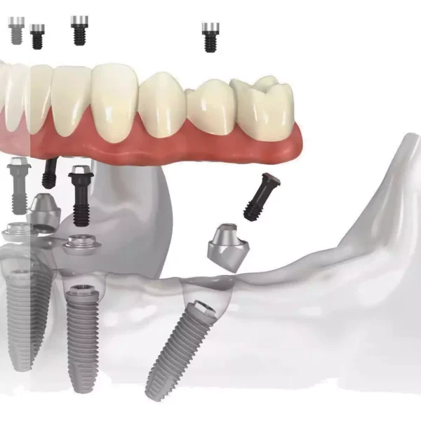 زراعة الأسنان في الفك السفلي تتطلب الكثير من الإجراءات والفحوص الطبية اللازمة مع طبيب تخدير محترف بحيث لا يكون هناك أي انعكاسات سلبية خلال عملية الزراعة.
