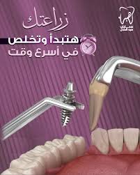 زراعة اسنان فورية . عيادة دكتورة هبة العدل