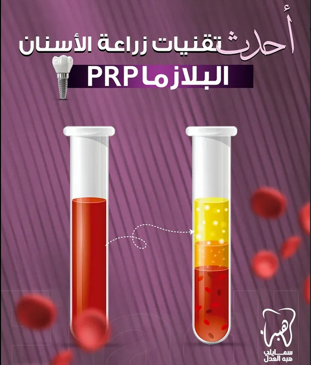 لازما الاسنان و اهميتها فى زراعة الاسنان