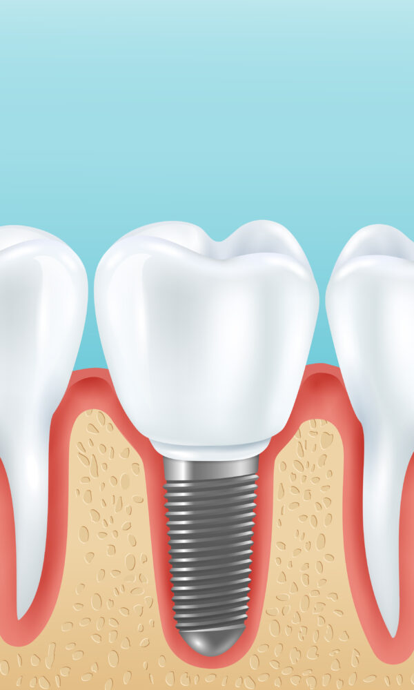 زراعة الأسنان بأحدث التقنيات بدون ألم ونتائج تدوم سنوات. تعرف على المميزات، الأسعار، ونصائح اختيار أفضل دكتور لزراعة الأسنان في مصر. احجز الآن.