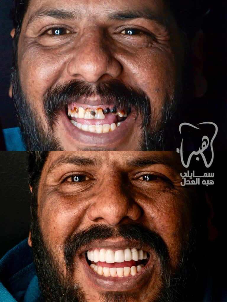 حالات قبل و بعد زراعة الفك العلوى للاسنان