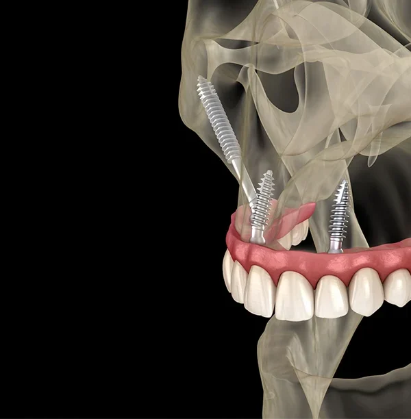 ما هى زراعة اسنان الترجويد ؟ هي تقنية زراعة أسنان متقدمة تُستخدم عندما يكون عظم الفك العلوي غير كافٍ لدعم الزرعات التقليدية. تُعد هذه التقنية حلاً للمرضى الذين يعانون من نقص شديد في العظام أو لا يمكنهم الخضوع لعمليات ترقيع العظام المعقدة