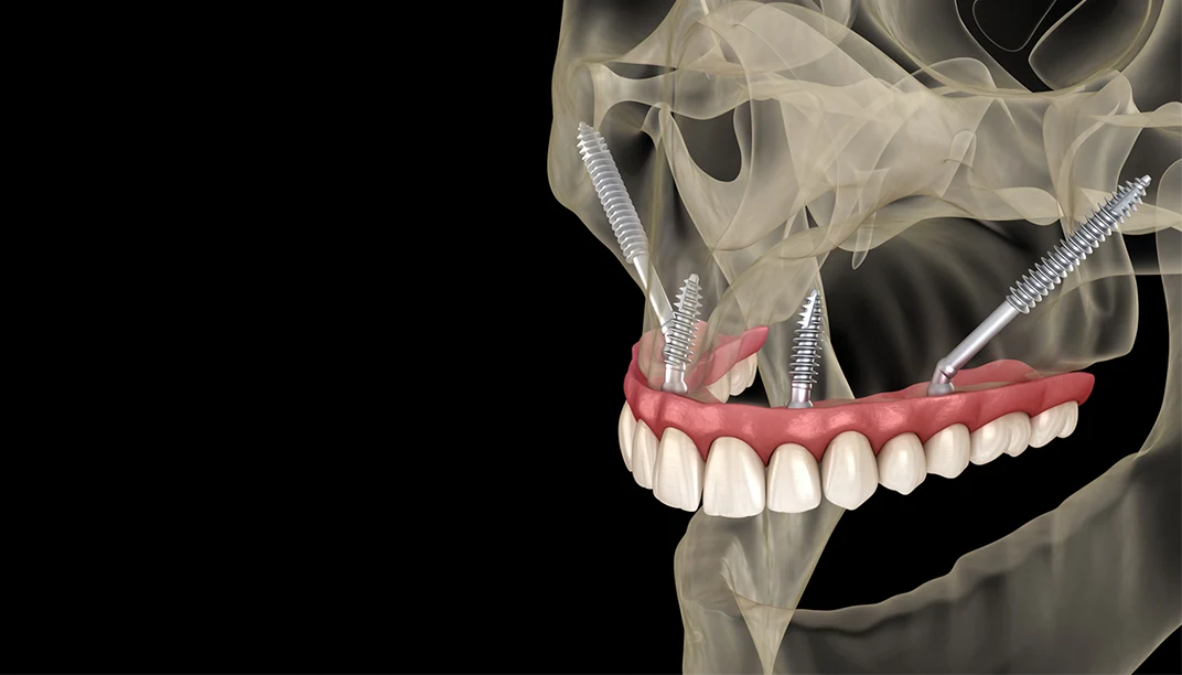 ما هى زراعة اسنان الترجويد ؟ هي تقنية زراعة أسنان متقدمة تُستخدم عندما يكون عظم الفك العلوي غير كافٍ لدعم الزرعات التقليدية. تُعد هذه التقنية حلاً للمرضى الذين يعانون من نقص شديد في العظام أو لا يمكنهم الخضوع لعمليات ترقيع العظام المعقدة