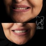 تبيض الاسنان و تجميل الاسنان