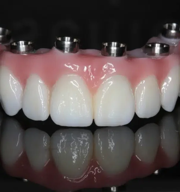 زراعة الأسنان بعد الخلع مباشرة حل ممتاز… بس مش حل سحري. اللي يحدد نجاحها مش الإعلان، لكن: التشخيص التخطيط خبرة الطبيب والتزام المريض والدكتور الشاطر هو اللي يقول: “آه ينفع” أو “لأ… نستنى أحسن.”