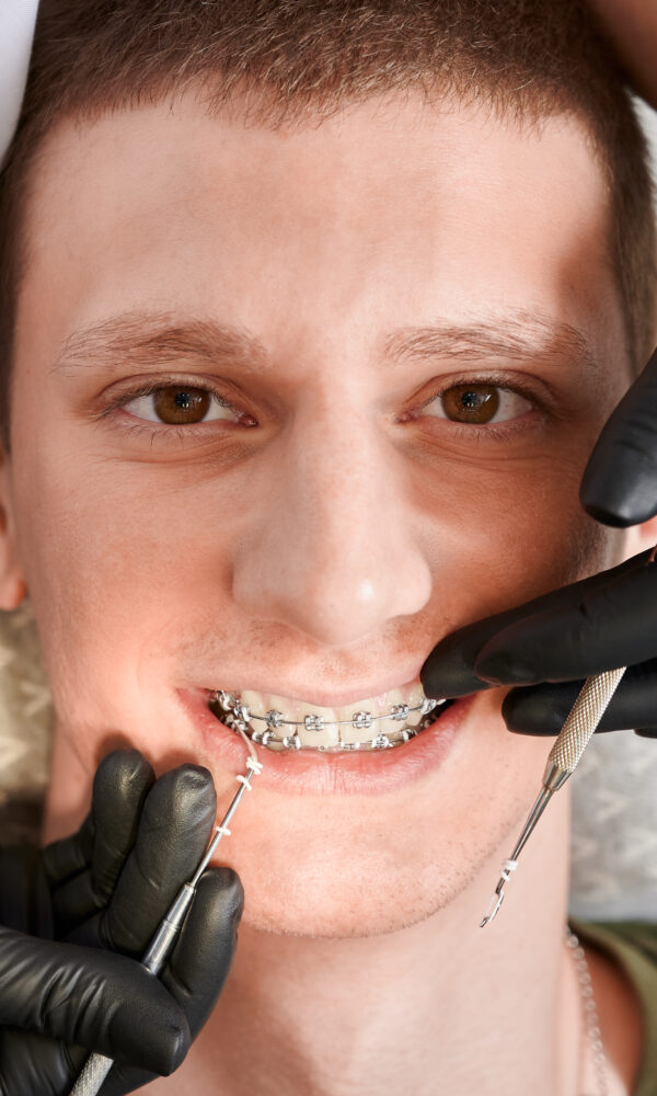 30 سنة في تقويم الأسنان، أؤكد أن التقويم المعدني ما زال من أقوى وأنجح الحلول لعلاج بروز الفك العلوي في حالات كثيرة، سواء للمراهقين أو الكبار.