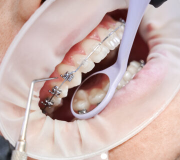 تقويم الاسنان المعدنى "ازدحام الأسنان مش مشكلة شكل بس… ده خطر على صحة اللثة والأسنان، وده السبب اللي بيخلينا نرشح تقويم الأسنان المعدني في الحالات الصعبة."