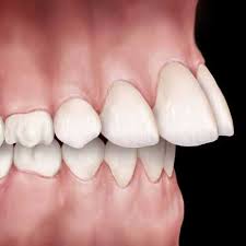 بروز الفك العلوي | الأسباب وطرق العلاج بتقويم الأسنان فى عيادة دكتورة هبة العدل 