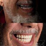 صورة قبل و بعد زراعة الفكين