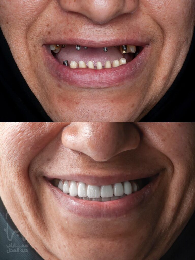 حالة زراعة الفك العلوى كامل فى عيادة اسنان دكتورة هبة العدل