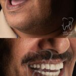 زراعة الفك العلوى كامل فى عيادة دكتورة هبة العدل . زراعة اسنان فى مصر
