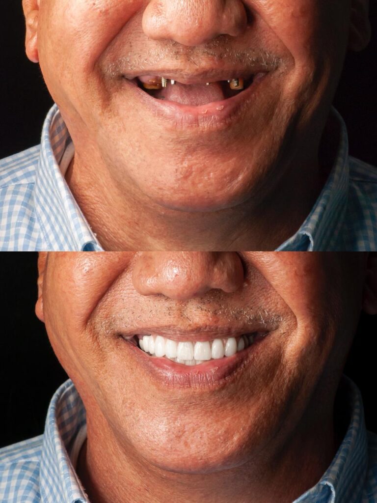 حالة زراعة الفك العلوى فى مصر . فى عيادة دكتورة هبة العدل . افضل دكتور اسنان فى مصر