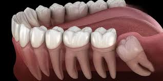 ضرس العقل المدفون داخل الللثة ضرس العقل المدفون داخل اللثة . فى عيادة دكتورة هبة العدل . افضل دكتورة تجميل و جراحة الفك فى مصر