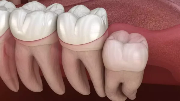 ضرس العقل المدفون داخل اللثة . فى عيادة دكتورة هبة العدل . افضل دكتورة تجميل و جراحة الفك فى مصر