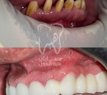 صورة توضح زراعة الفك العلوى و السفلى للاسنان