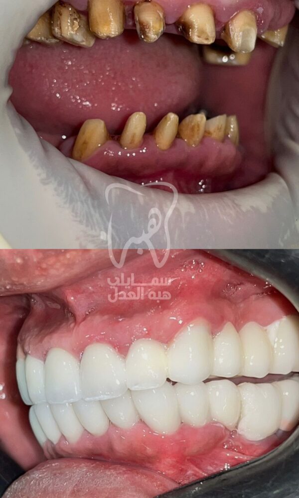 صورة توضح زراعة الفك العلوى و السفلى للاسنان
