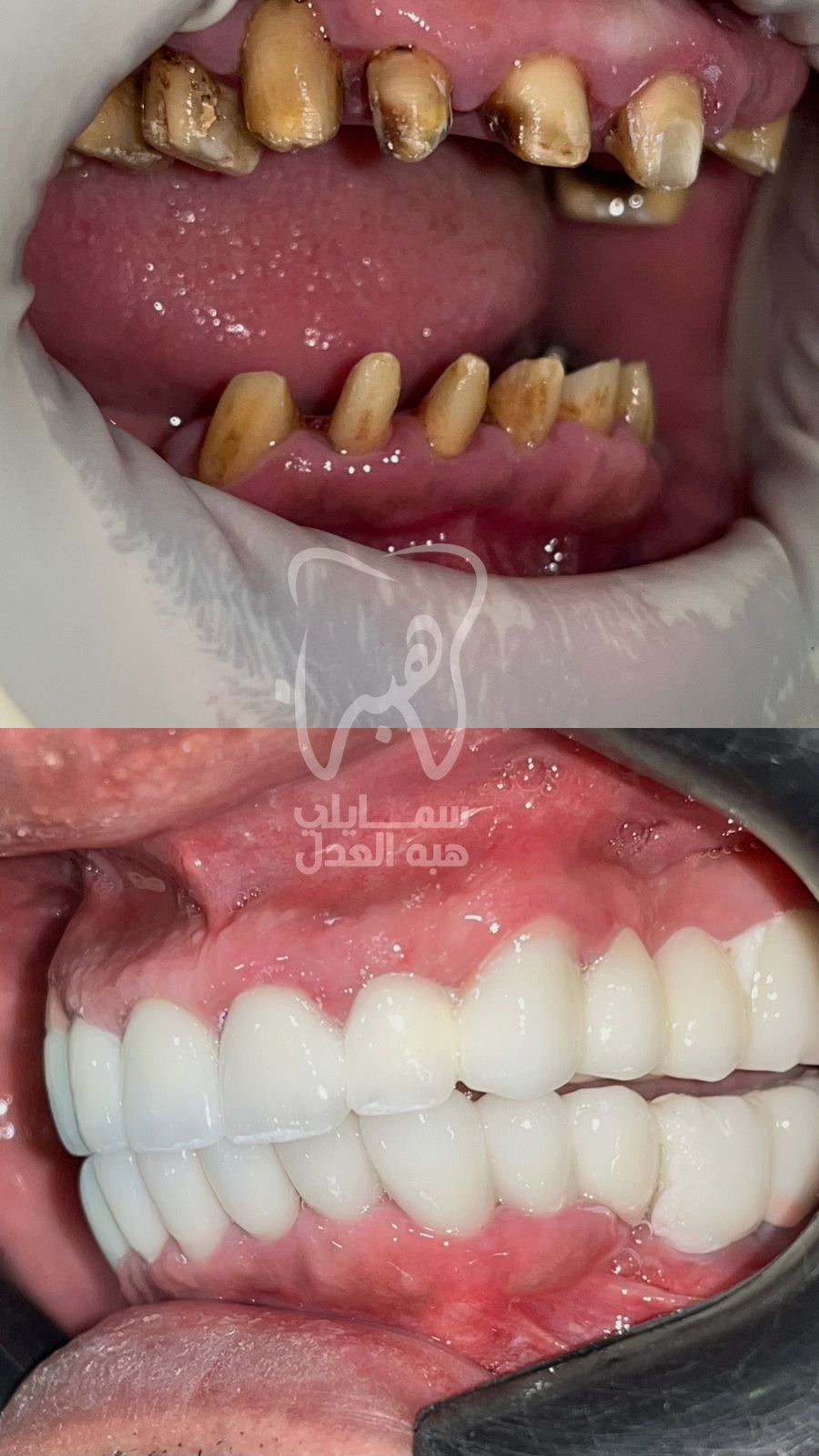 صورة توضح زراعة الفك العلوى و السفلى للاسنان