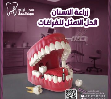 زراعة الاسنان فى عيادة دكتورة هبة العدل - افضل عيادة اسنان فى مصر