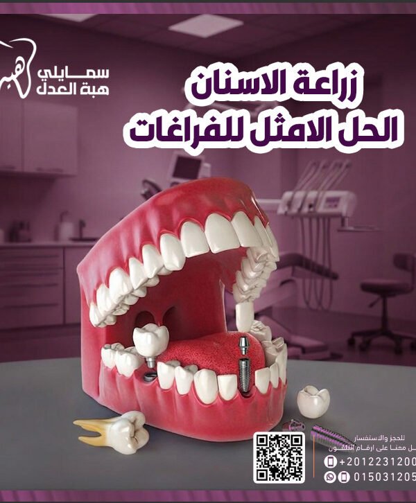 زراعة الاسنان فى عيادة دكتورة هبة العدل - افضل عيادة اسنان فى مصر