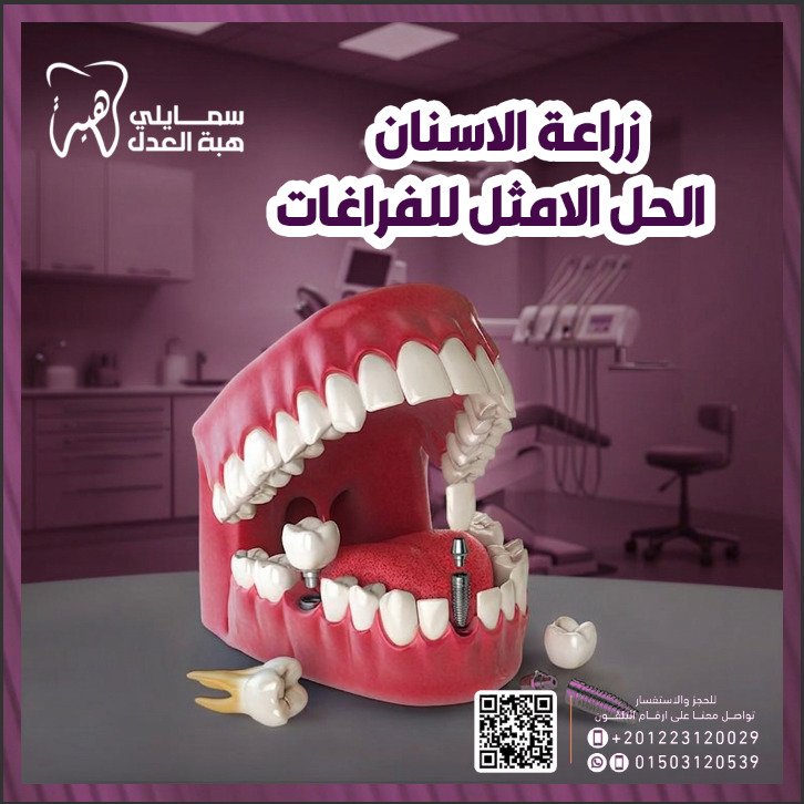 زراعة الاسنان فى عيادة دكتورة هبة العدل - افضل عيادة اسنان فى مصر