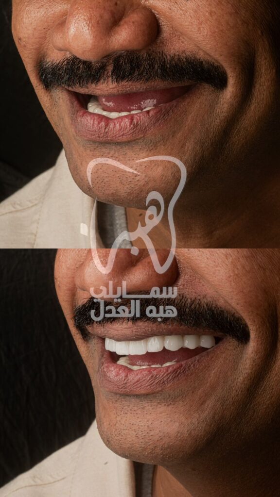 علاج الاسنان فى عيادة دكتورة هبة العدل