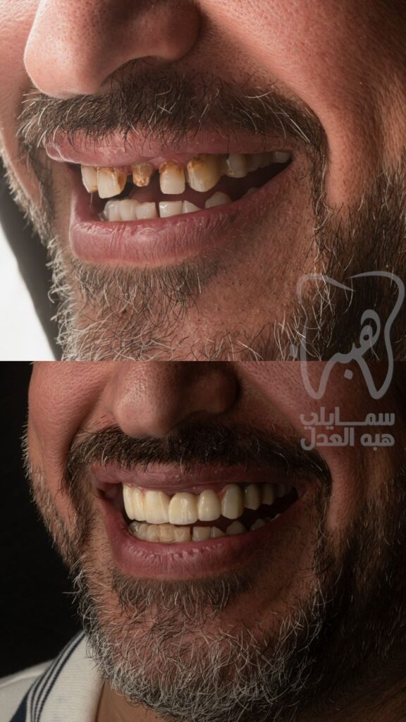 حالة زراعة الفك العلوى . قبل و بعد الزراعة . عيادة دكاورة هبة العدل