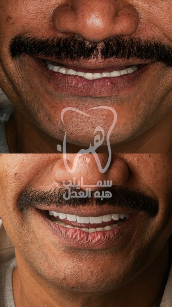 صور قبل و بعد . زراعة الاسنان فى عيادة دكتورة هبة العدل