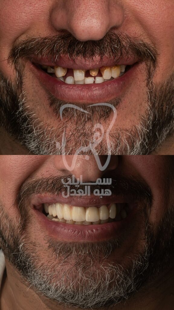 فينير-الاسنان-بيخلى-الشكل-عامل-ازى-.-عيادة-دكتورة-هبة-العدل