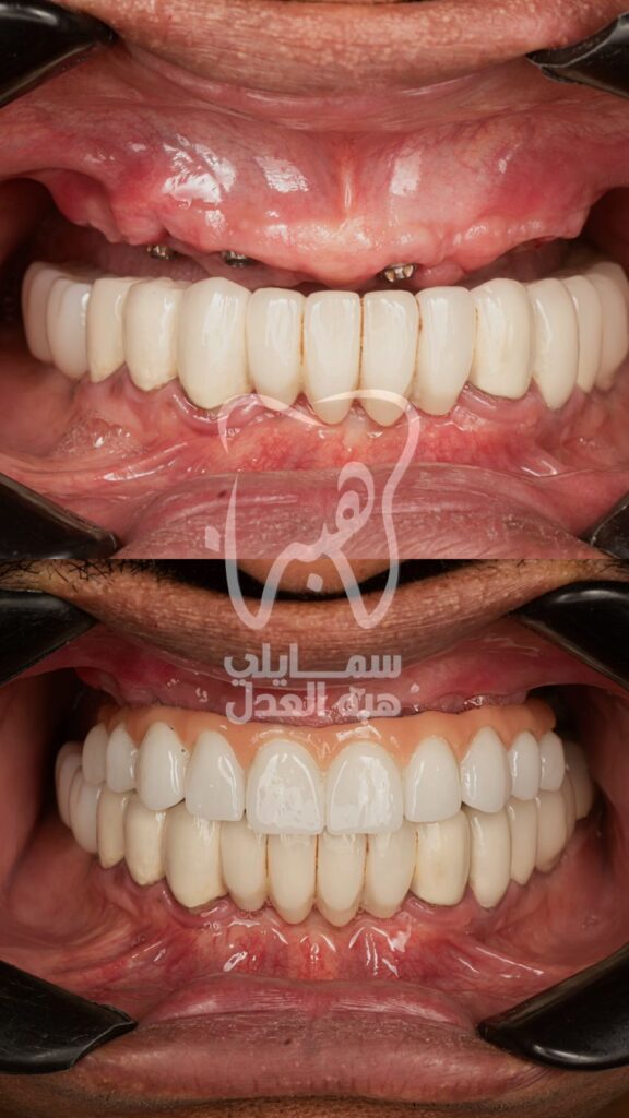 مراحل زراعة الاسنان قبل و بعد . عيادة دكاورة هبة العدل